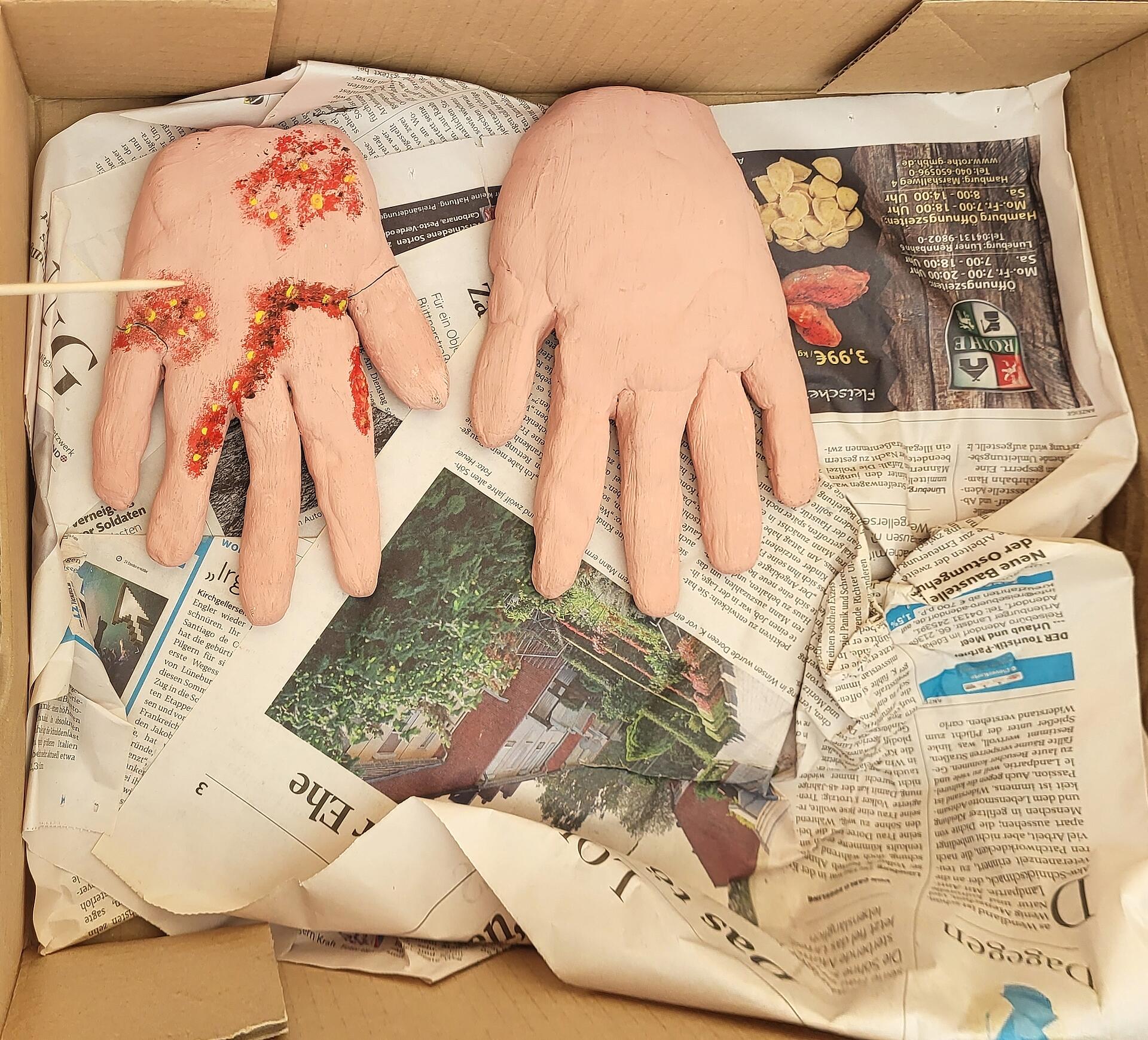 Zwei Handmodelle auf Zeitungspapier, eine Hand ist mit roten Entzündungsmalen versehen und eine ist normal